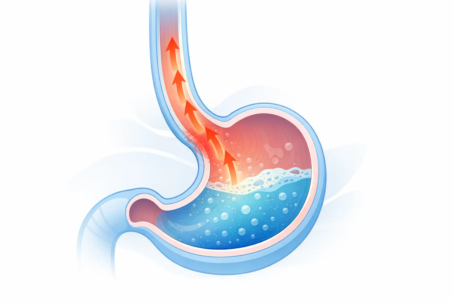 Schema dello stomaco e dell’esofago con frecce che indicano la risalita del contenuto gastrico